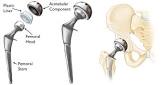 Acetabular Cup
