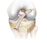 Acl Screws