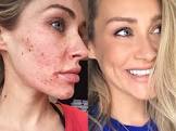 Acne Laser Treatment
