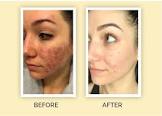 Acne Treatment Services