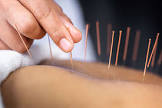 Acupuncture Therapy