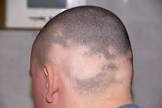Alopecia Areata Treatment Services