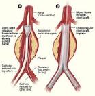 Aortic Surgery
