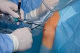 Arthroscopic Surgery