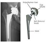 Artificial Hip Joints
