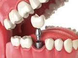 Artificial Teeth Services