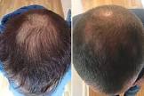 Baldness Treatment