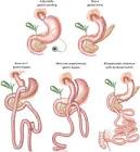 Bariatric Surgery