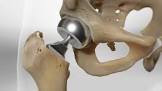 Bipolar Hip Prosthesis