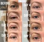 Blepharoplasty Surgery