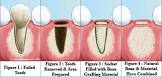 Bone Grafting