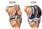 Bone Prosthesis
