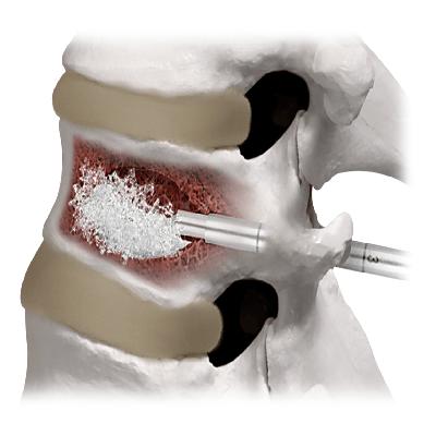 Bone Cement 