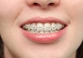 Braces Services
