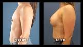 Breast Implant Surgery
