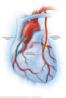 Cabg Surgery