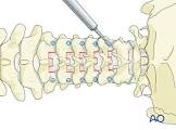 Cervical Bone Screw