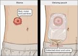 Colostomy Bag