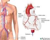 Coronary Angiography