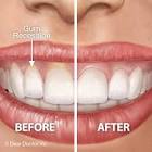 Cosmetic Gum Surgery