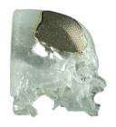 Cranio Maxillofacial Implants
