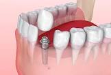 Dental Implant Surgery
