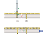 Dynamic Compression Plate