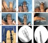 Dynamic External Fixator