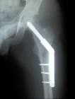 Dynamic Hip Screw (dhs)