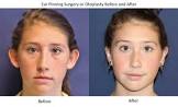 Ear Surgery (otoplasty)