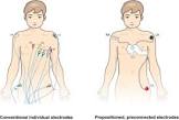 Ecg Electrode