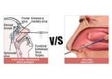 Endoscopic Sinus Surgery