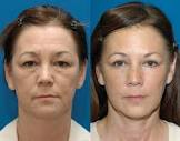 Eyelid Surgery