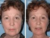 Face Lift Surgery