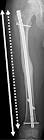 Femoral Nail