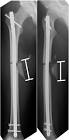 Femur Nail