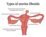 Fibroid Treatment