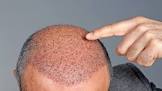 Follicular Hair Transplant