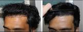 Fue Hair Transplant Service
