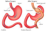 Gastro Surgery