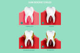 Gingivitis Treatment