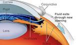 Glaucoma Surgery