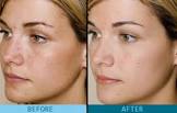 Glycolic Acid Peels