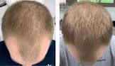 Hair Loss Treatment Services
