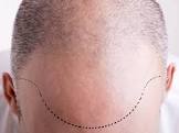 Hair Transplant Cosmetic Surgery