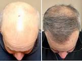 Hair Transplantation