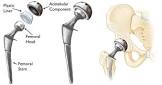 Hip Prosthesis