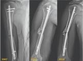 Humerus Nail