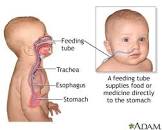 Infant Feeding Tube