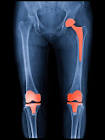 Joint Replacement Surgery